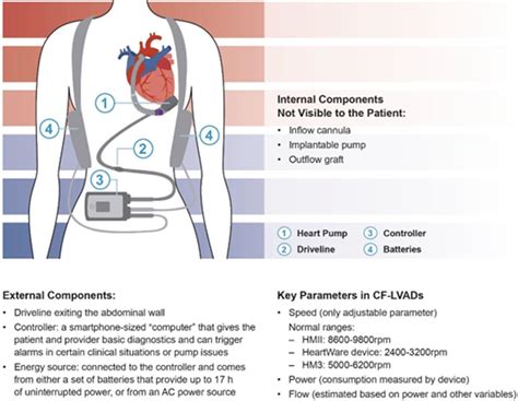 Left Ventricular Assist Devices: A Primer For the .